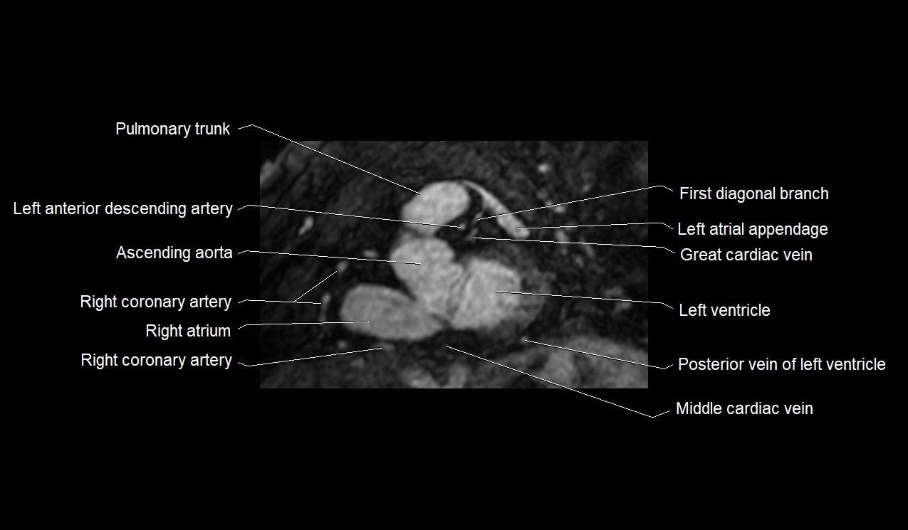 MRI heart and coronary arteries short axis anatomy image 18.webp